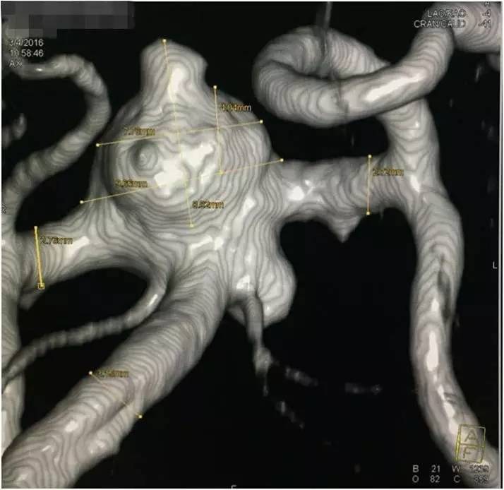 基底动脉顶端动脉瘤加左侧小脑上动脉瘤以Y型支架结合弹簧圈栓塞