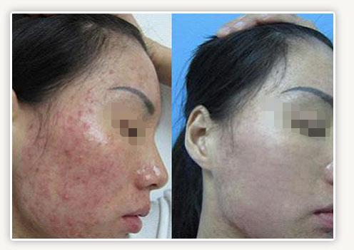 激素脸擦护肤品刺痛是怎么回事,激素脸洗脸会刺痛吗