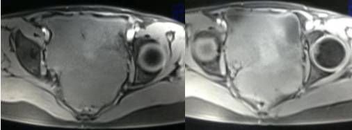 中下腹胀痛见于哪些疾病,女性下腹坠痛是不是有炎症