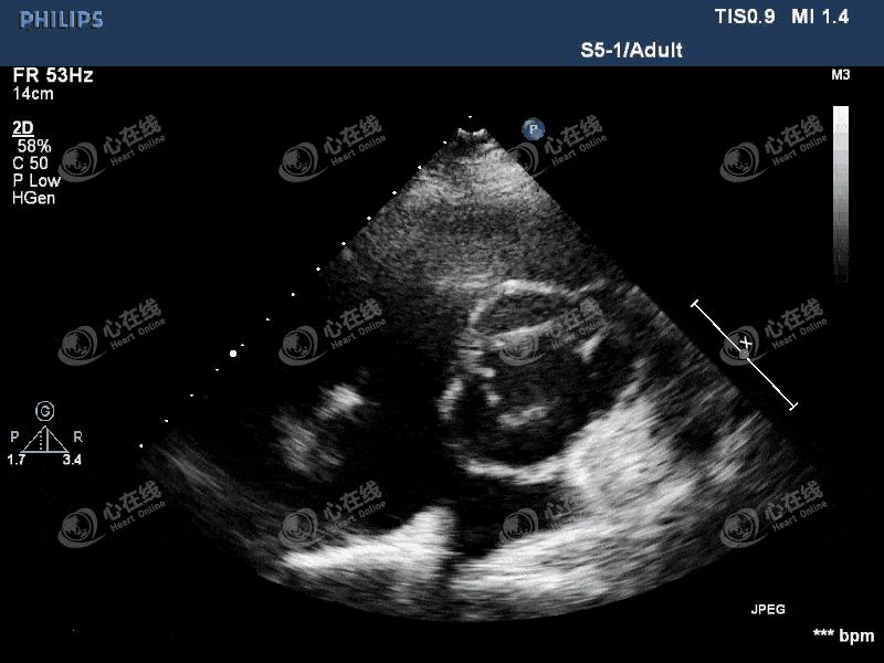 「“医”站到底」26：主动脉瓣机械瓣置换术后发热，您答对了吗？