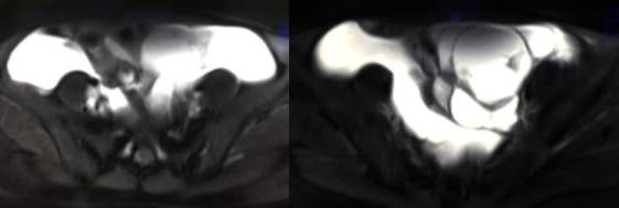 中下腹胀痛见于哪些疾病,女性下腹坠痛是不是有炎症