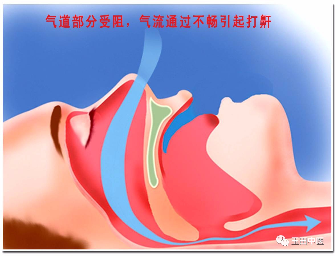 医院用便携式睡眠呼吸监测仪,睡眠监测软件打鼾