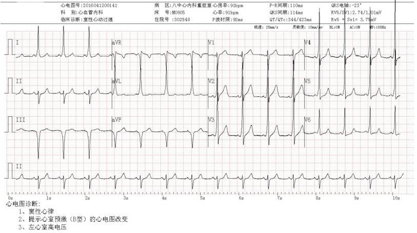 预激综合征伴房颤的首选治疗,预激综合征合并房颤首选治疗药物