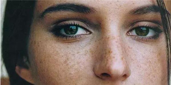 皮肤科医生教你去脸上长斑,皮肤医生讲斑的分类