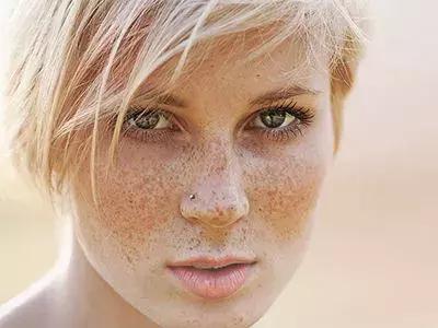 皮肤科医生教你去脸上长斑,皮肤医生讲斑的分类