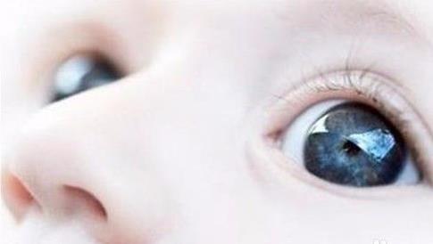 孩子斜视治疗最佳时间表,斜视最严重多少度