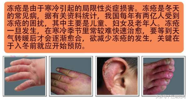 冻疮痒得受不了怎么办,冻疮很痛怎么办