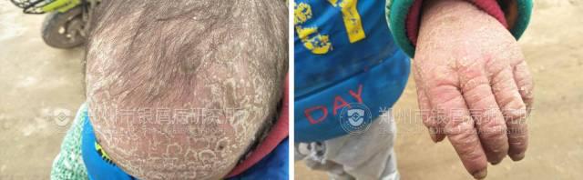 案例分享|四岁男童因误治变成沙皮人！