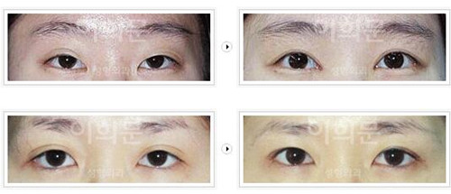 二次修复双眼皮恢复过程,二次修复双眼皮的过程