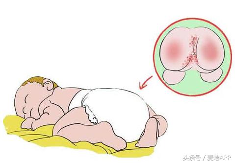 CTY：尿布疹原因及症状与多效修复凝胶治疗护理方式！