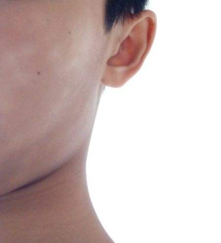 男孩脸上一块块白斑应该怎么弄,孩子脸上长了一块白斑怎么回事