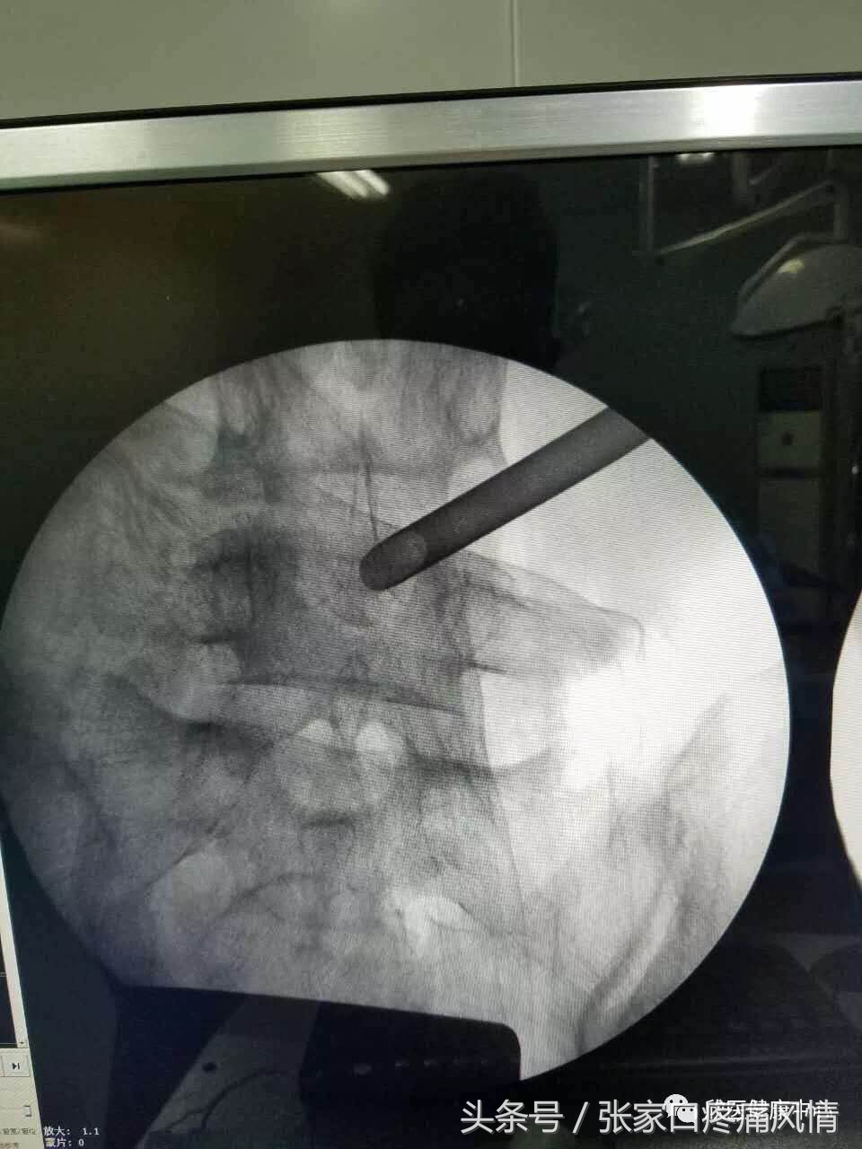 丹鹿通督丸治腰间盘突出效果好吗,治疗腰间盘突出的膏药哪个牌子好