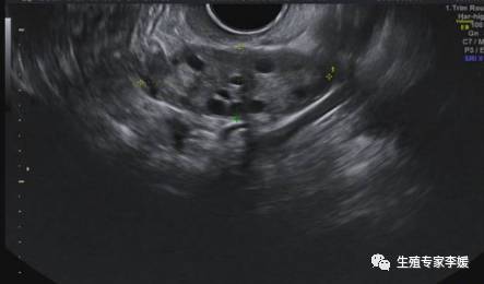 做试管婴儿期间要频繁去医院吗,为什么做试管要反复b超抽血