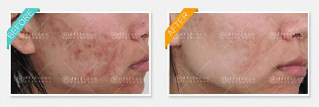 青春痘有什么方法解决,青春期已经长痘了怎么改善皮肤