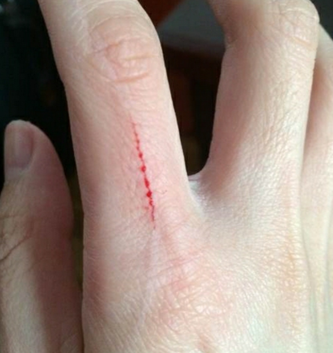 不小心划破手该怎么办,手划破了怎么处理没有碘伏