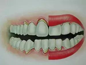 五十牙齿松动什么原因,牙齿松动的4个原因