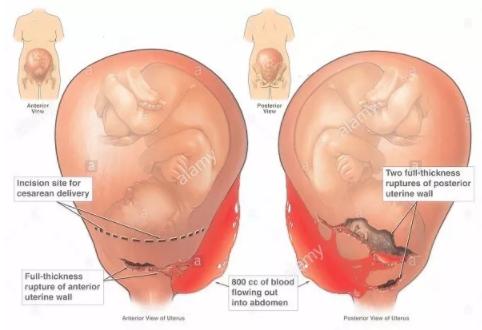 哪些女星是剖腹产,哪些女星是剖腹产的