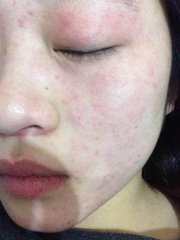 眼球充血会一直不消除么,晚上眼球充血是什么原因引起的