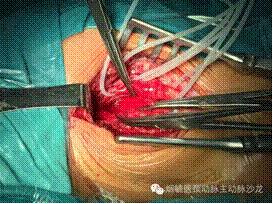 胃动脉溃疡,胃溃疡的溃疡点在主动脉