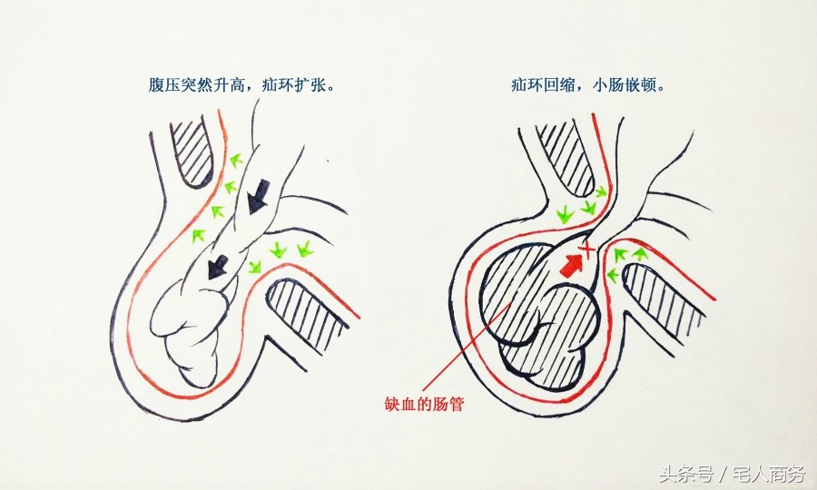 疝气食疗方法视频教程,儿童疝气食疗的最佳方法