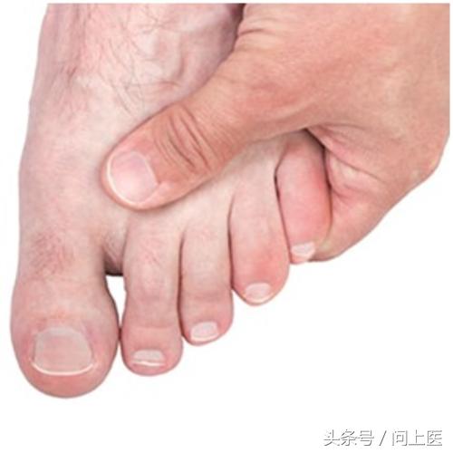 大脚趾关节炎怎么才能好,脚拇指关节炎症状有哪些表现