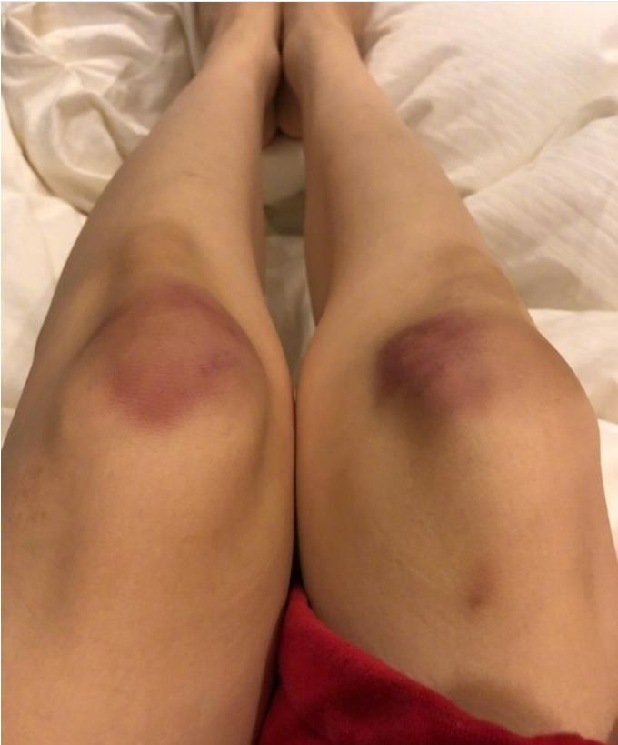 范玮琪受伤的原因,范玮琪受伤事件