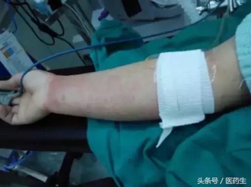 遇到过敏性休克我们应该做什么,预防接种过敏性休克处置原则