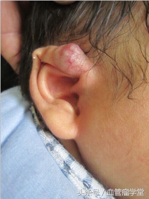 耳部也长血管瘤？4种分型的危害及治疗一篇读懂