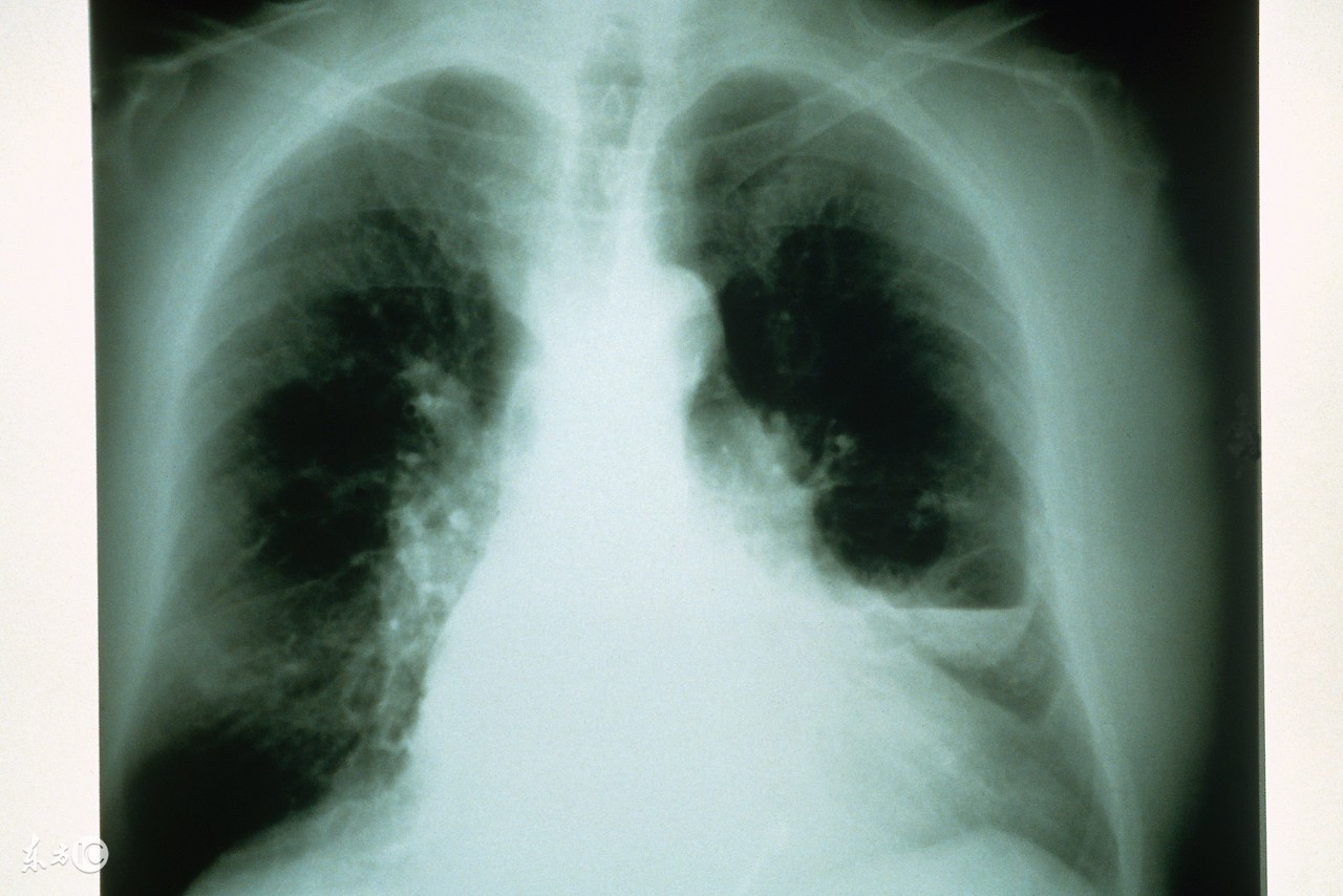 支气管炎最佳食疗法,支气管炎有效的食疗方法