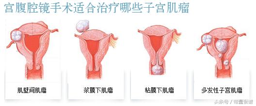 子宫肌瘤一般良性还是恶性肿瘤,子宫肌瘤是良性肿瘤