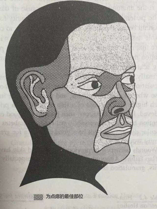 乳房上长的痣可以用激光点掉吗,什么样的痣适合激光点痣