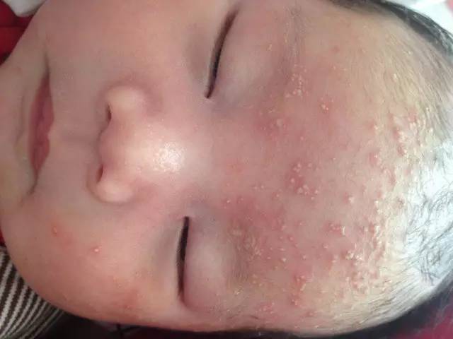 宝宝湿疹痒痒的有什么办法治好吗,宝宝湿疹好了皮肤痒怎么办
