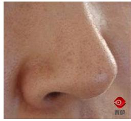 鼻翼两侧脏脏的,为什么鼻翼总是卡粉