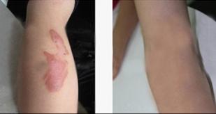 蒸汽烫伤留下的疤痕怎么有效去除,水蒸气烫伤怎么处理会留疤吗