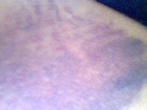 鼻炎咽炎反复发作中医怎么调理,慢性咽炎鼻炎调理方法