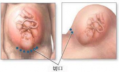 剖宫产分娩选择,剖腹产和顺产到底该如何选择