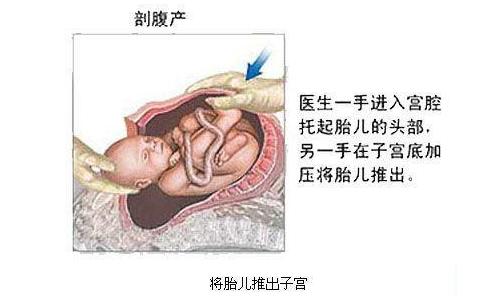 经历了剖腹产才知道妈妈的不容易,看完剖宫产过程你就会明白