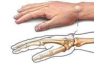 手腕血管周围有肿块是怎么回事,手腕上有突出的肿块能按摩下去吗