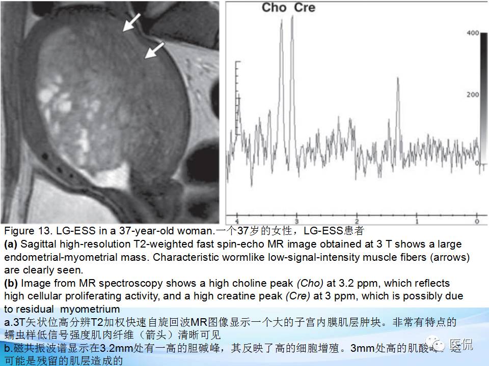 双语PPT：子宫腺肌症常见和不常见的MRI表现医学影像