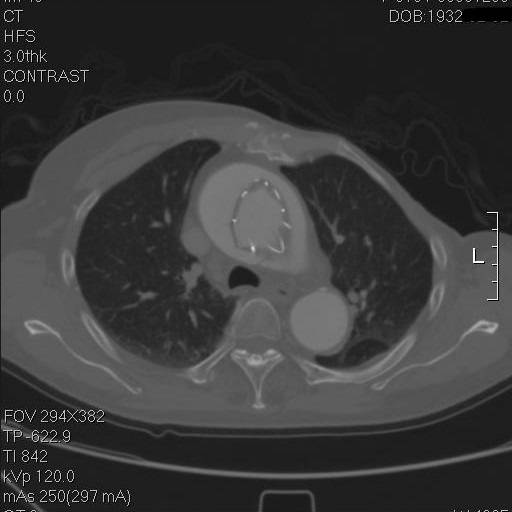 主动脉夹层早期征兆35岁,主动脉夹层早期征兆心率