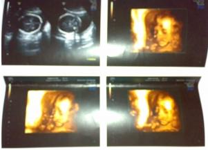 超准！轻轻松松看胎儿“性别”，准妈妈需学习一下这简单方法