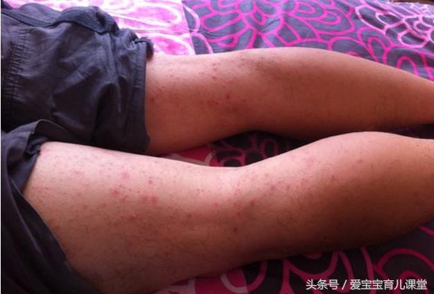 小孩去公园玩身上起红疙瘩怎么办,小孩去公园玩脸上起红疙瘩怎么办