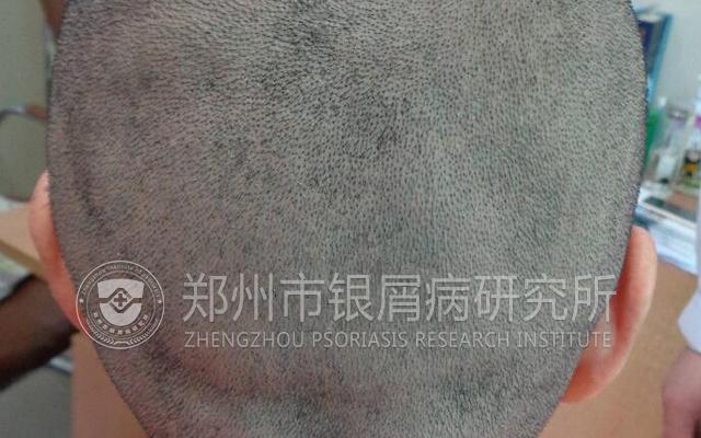 银屑病绝不能忌口,银屑病真的不能用激素么