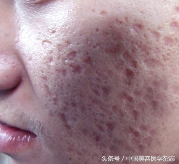 刚形成的小痘坑可以恢复过来吗,痘痘怎样的情况下会形成痘坑