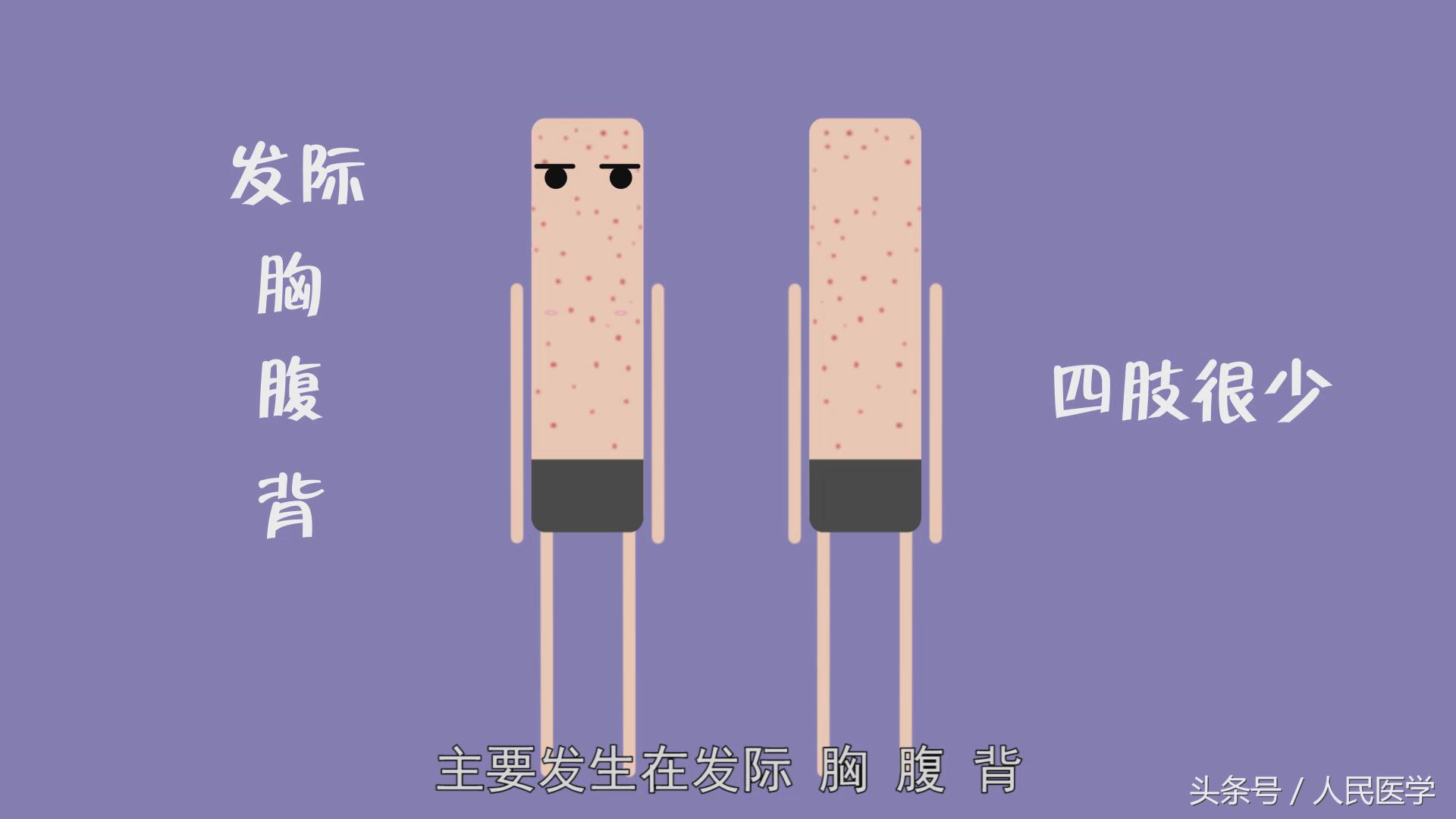 学校水痘疫情处置方案,学校水痘疫情