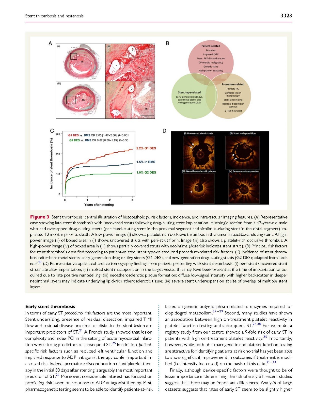 支架内血栓怎么处理,支架内血栓的原因及表现