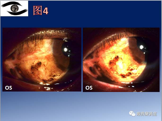 几种眼病的视野图,看图识病是什么病