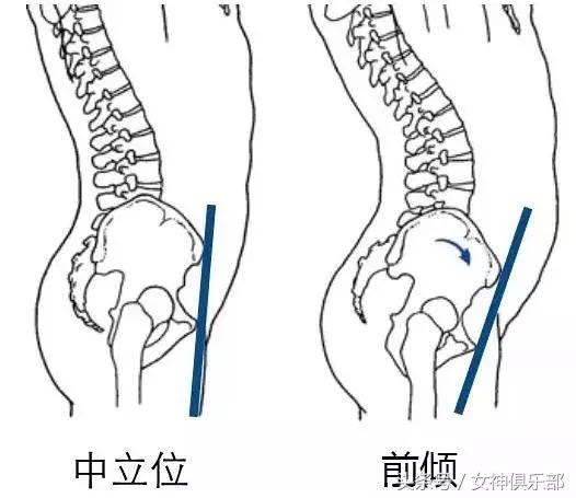 怀孕骨盆前倾最快纠正法产后恢复,产后恢复中心修复骨盆前倾