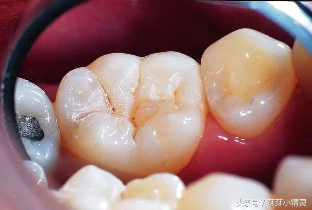 窝沟封闭注意事项,虫牙可以做窝沟封闭吗