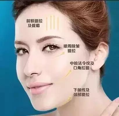 线雕提升的效果图,线雕青春定格术多久消肿